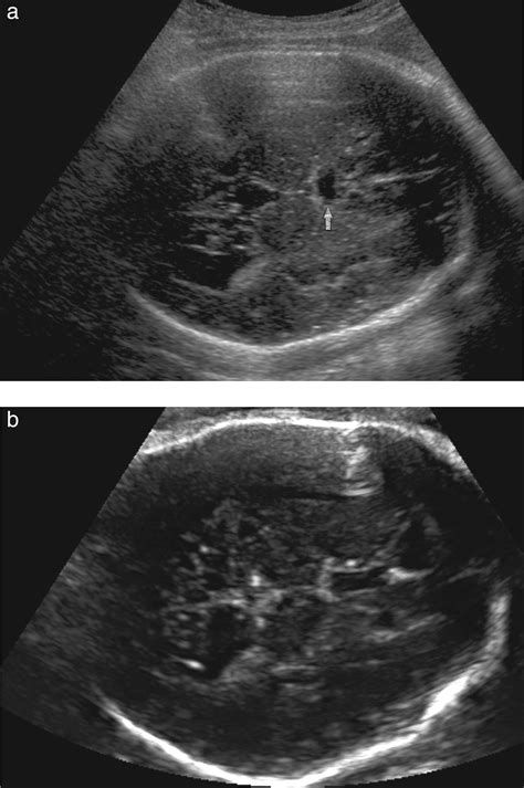 Abnormal Shape Of The Cavum Septi Pellucidi An Indirect Sign Of