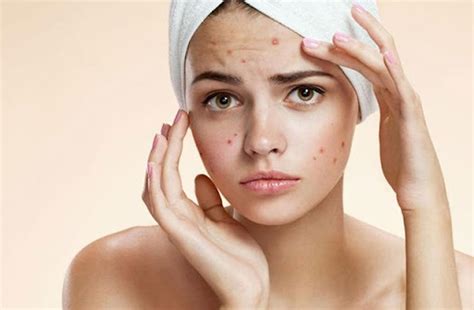 The Emotional Toll Of Acne Skinthetics Cosmetic Clinic