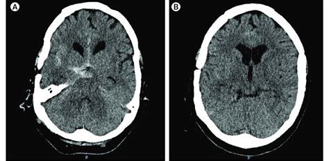 Head Computed Tomography Ct Scan A Subarachnoid Hemorrhage Is