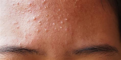Forehead Acne Pimple Causes Treatments Prevention And Results