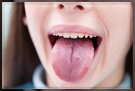 Sore Tongue Causes Treatment And Remedies Dentist Ahmed