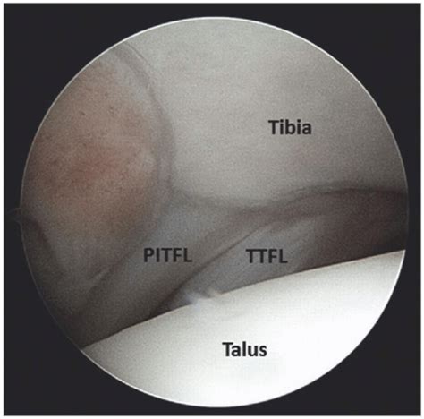 Principles Of Ankle Arthroscopy Musculoskeletal Key