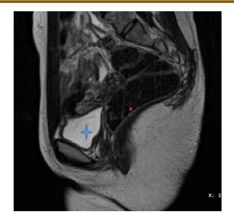 Figure 2 From A Case Of Mayer Rokitansky Kuster Hauser Mrkh Syndrome