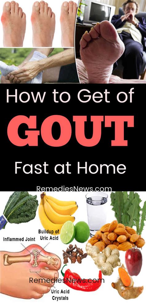 How To Get Rid Of Gout Fast With 11 Best Home Remedies