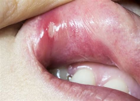 What You Need To Know About Cold Sores Vs Canker Sores Mouth Ulcers