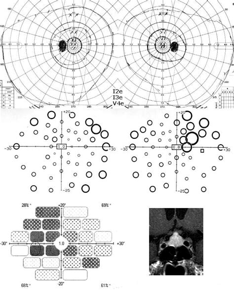 Neuro Ophthalmology Nuggets Visual Fields