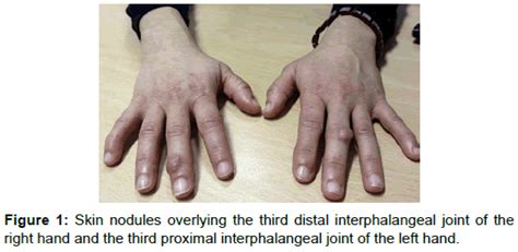 Clinical Cellular Immunology Interphalangeal Joint