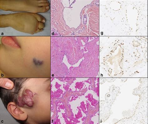 Clinical Features Of A Microcystic Lymphatic Malformation Of The Foot