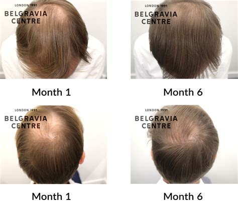 Hair Loss Success Story Good Results And Nice Team