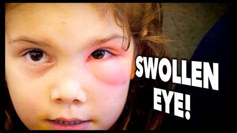 Swollen Eye Periorbital Cellulitis Dr Paul Youtube