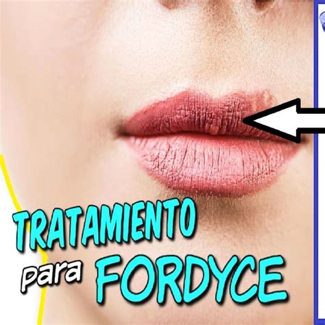 Fordyce Tratamientos Beauty Hacks Fordyce Beauty