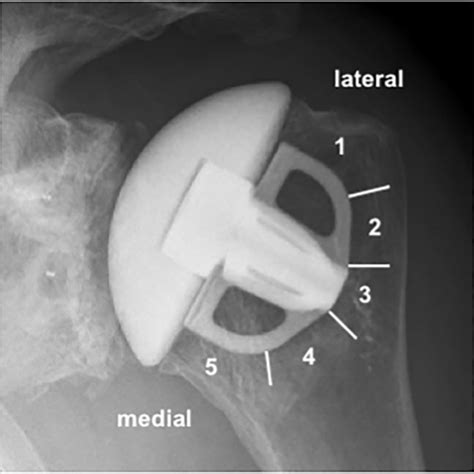 A Radiograph Demonstrates The Humeral Component Of The Prosthesis The