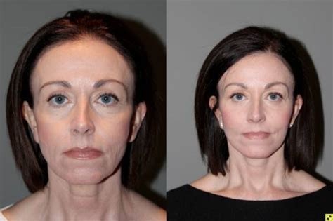 🥇 Atlanta Facial Cosmetic Surgeon Buckhead Face Plastic Surgery