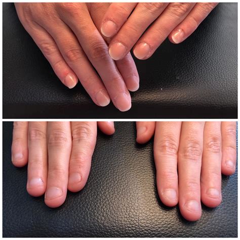 My Nails Before And After Gelnails Rnailbiting
