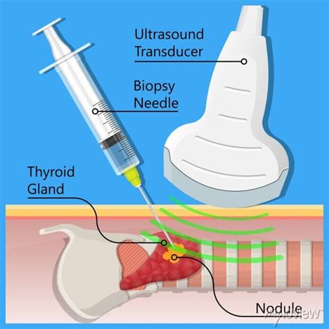 Thyroid Fine Needle Aspiration Biopsy Procedure Sample Tissue Canvas