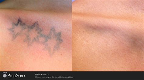 Laser Ink - PicoSure Laser Tattoo Removal Specialists - Bedford New