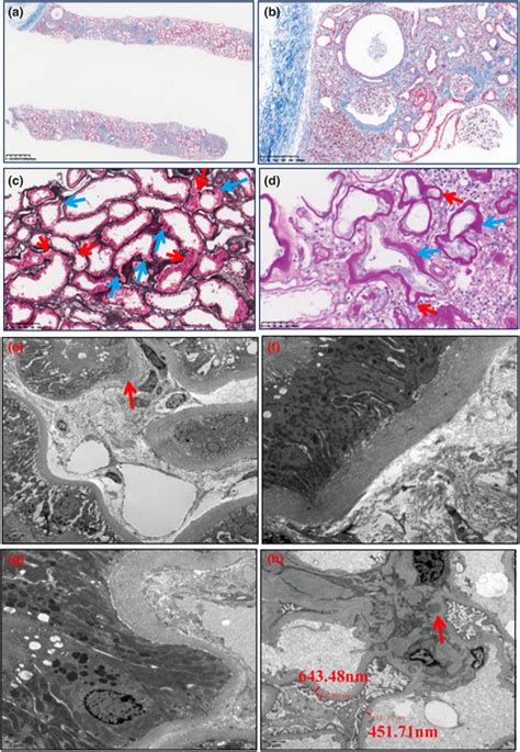 A Single Heterozygous Nonsense Mutation In The Ttc21b Gene Causes Adult