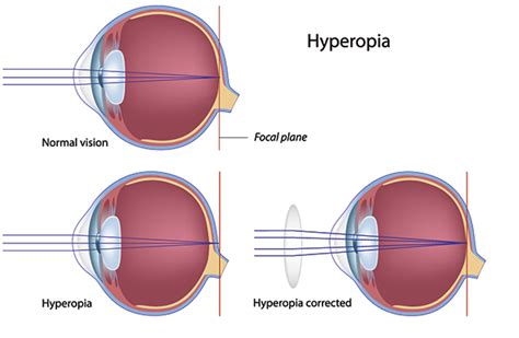 Hyperopiafarsightedness Symptoms Causes And Treatment How To Relief
