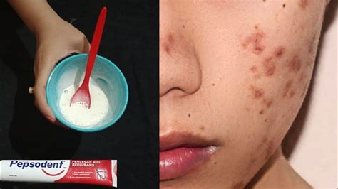 Jul 05, 2021 · read more menghilangkan bintik bintik di photoshop / cara menghilangkan bintik hitam di baju. Cara Menghilangkan Flek Hitam Dan Bintik Hitam Bekas ...