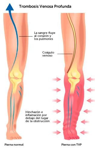 Read about dvt (deep vein thrombosis), including how to tell if you have a dvt and treatment. "Trombosis Venosa Profunda", por Irene Palomera.