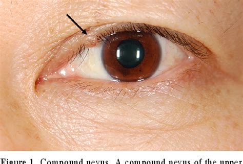 Figure 5 From Clinical Characteristics Of Benign Eyelid Tumors