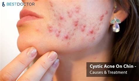Pimples start when a pore in your skin gets clogged, usually with dead skin cells. Cystic Acne On Chin - Causes & Treatment