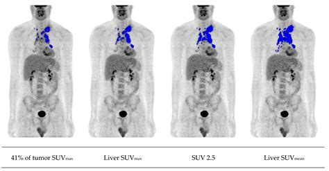 Cancers Free Full Text Fdg Pet Imaging For Hodgkin And Diffuse