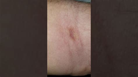 Spider Bite Full Recovery Scar Youtube