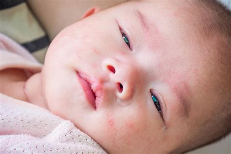 18 Rekomendasi Obat Biang Keringat Pada Bayi Yang Aman Usir Ruam Di