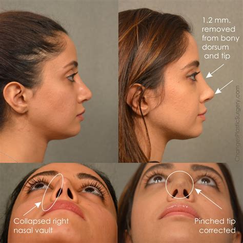 Plastic Surgery Before And After Rhinoplasty Photo Eb
