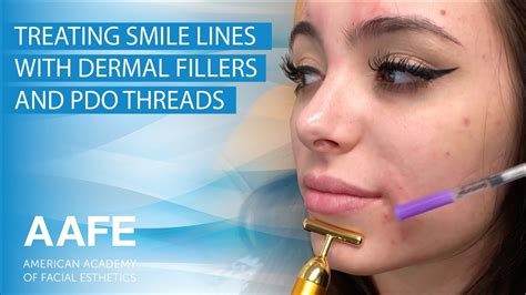Treating Smile Lines With Dermal Fillers And Solid Filler Pdo Threads Youtube