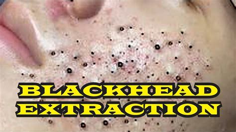Satisfying Blackhead Extraction Blackhead Compilation Youtube