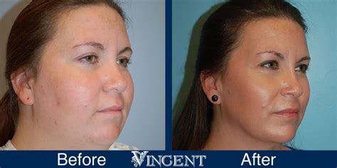 Vincent Surgical Arts Submental Lipsosuction In Cottonwood Heights