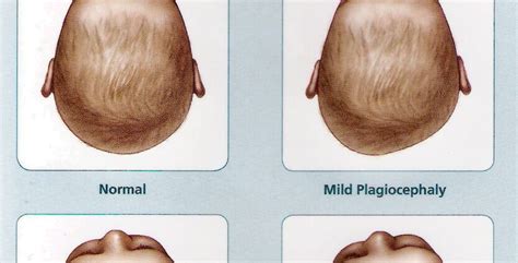 Flat Heads In Babies What Is Plagiocephaly Healthy Food Near Me