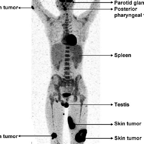 Positron Emission Tomography Computed Tomography Pet Ct Showed