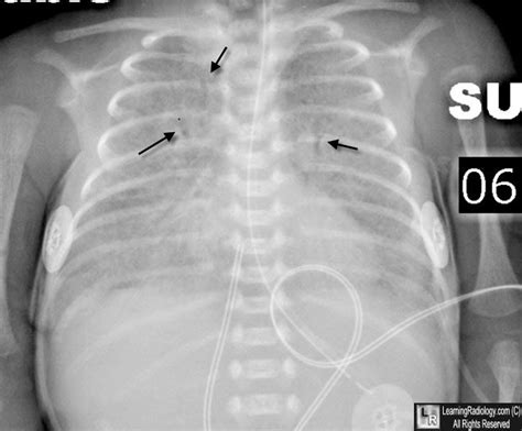 Rds Newborn Radiology Respiratory Distress Syndrome In The Neonate