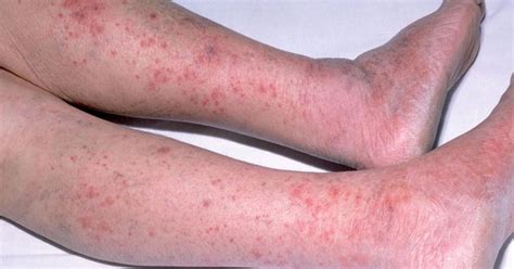 How To Spot Symptoms Of Deadly Meningitis Ahead Of Peak Season Cases