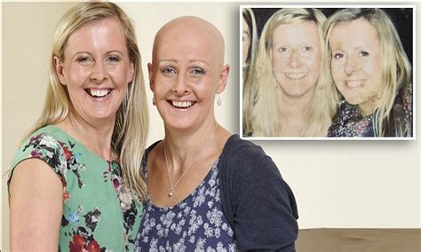 These Twins Couldnt Have Been Closer Until One Was Hit By Alopecia