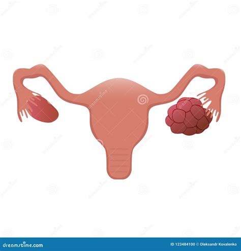 Polycystic Ovary Vector Illustration Stock Vector Illustration Of