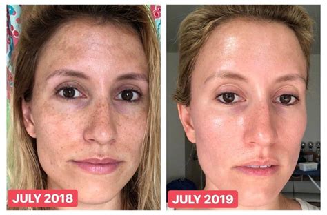 Beforeandafter One Year Tretinoin Vitamin C Sunscreen