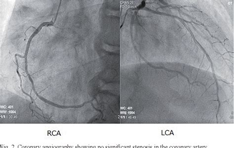 Figure 2 From A Rare Case Of Rapidly Progressing Beriberi Heart