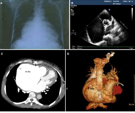 A Chest X Ray Shows The Dilated Right Atrium Ra B Two Dimensional