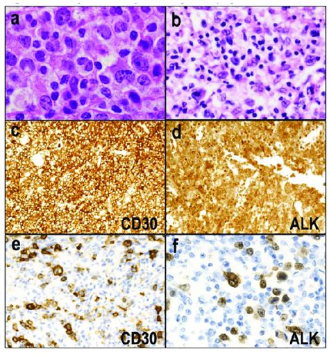 Alk Positive Anaplastic Large Cell Lymphoma Alcl A The Common