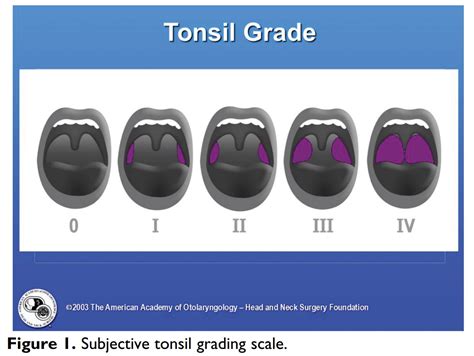 Subjective Tonsil Grading Scale 0 I Ii Iii Iv Tonsil Grepmed