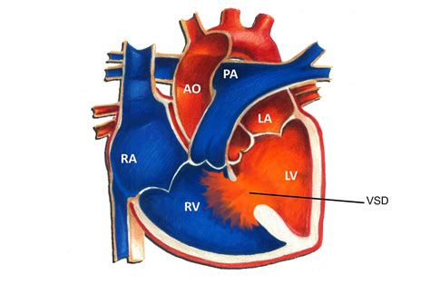 anatomy of the ventricular septal defect in congenital heart defects a my xxx hot girl
