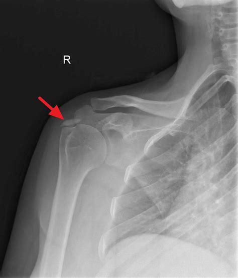 Rotator Cuff Calcific Tendinopathy Symptoms Causes And Treatment Hot Sex Picture