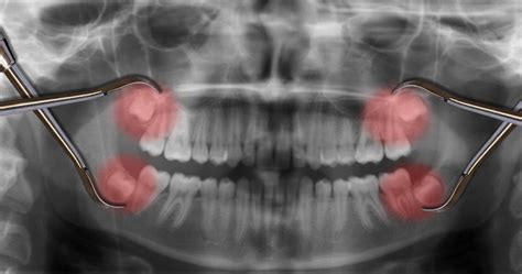 Can Wisdom Teeth Cause Migraines My Health And Wellness Info
