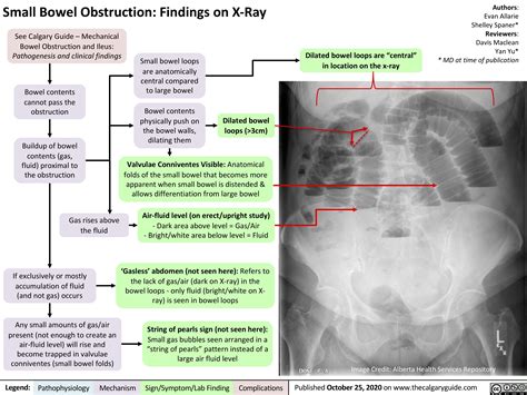 Small Bowel Obstruction Findings On X Ray Calgary Guide