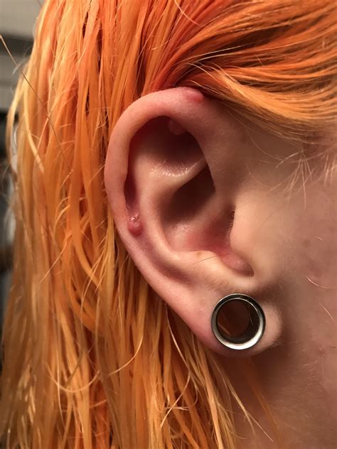 After 10 Months Of Hell I Took Out My Industrial Because It Was Not