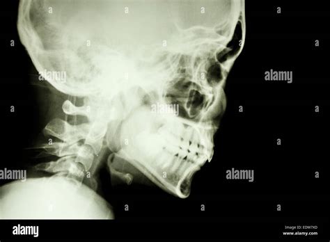 Normal Lateral Neck X Ray